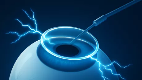 коррекция зрения электрическим током